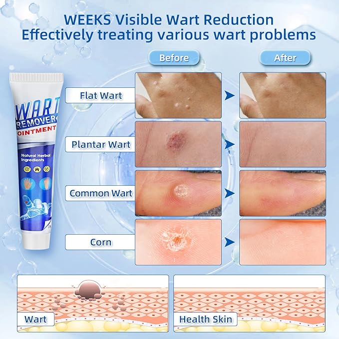 Fast-Acting Wart Remover Gel with Freeze Off Technology - Genital, Common Warts & Plantar wart Remover for Feet, Skin & Mor